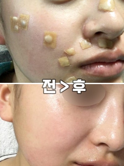 점뺀후 듀오덤 제거했는데 흔적 남았다면? 흉터 예방 홈케어 꼭 하세요..