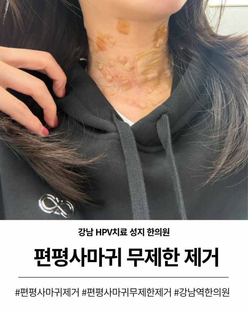 편평사마귀 무제한 제거 강남역 HPV 치료 성지 한의원 편사 제거 후기