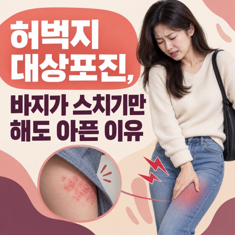 허벅지 대상포진, 바지가 스치기만 해도 아픈 이유