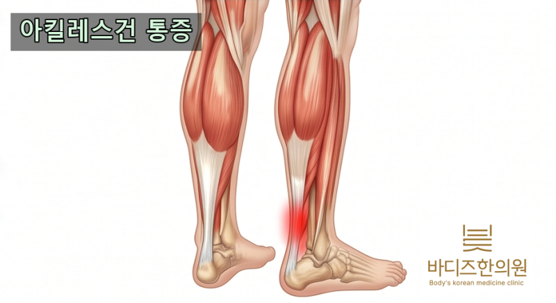 이천 아킬레스건 통증, 등상과 러닝 후 뻣뻣한 발뒤꿈치! 힘줄 파열을 막는 관리방법