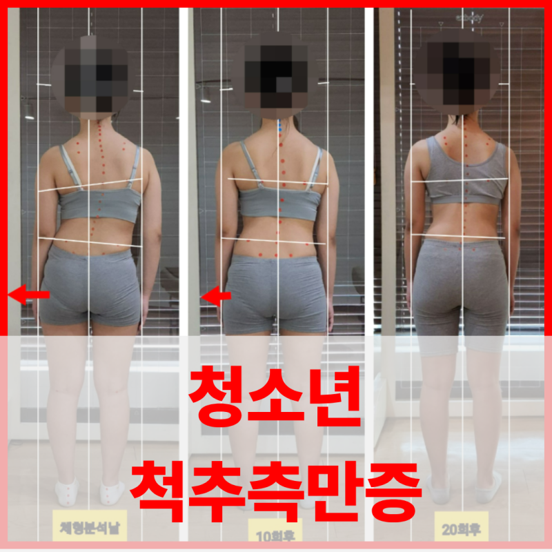 부산 서면 청소년 척추측만증, 운동 1회후 중학생 측만 변화