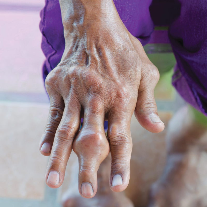 통풍 Gout: 왕의 병에서 ‘결정의 병’으로 — 통풍 2,500년의 추적