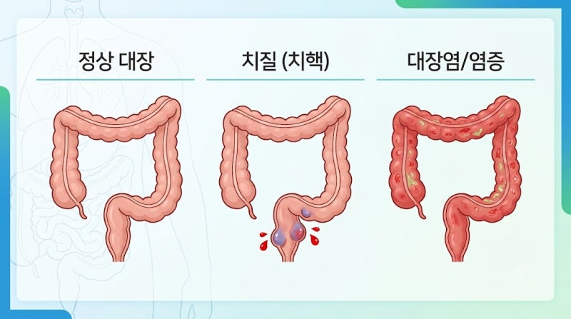 선홍색 혈변이면 치질일까 대장암 혈변과 구분할 때 꼭 봐야 할 6가지