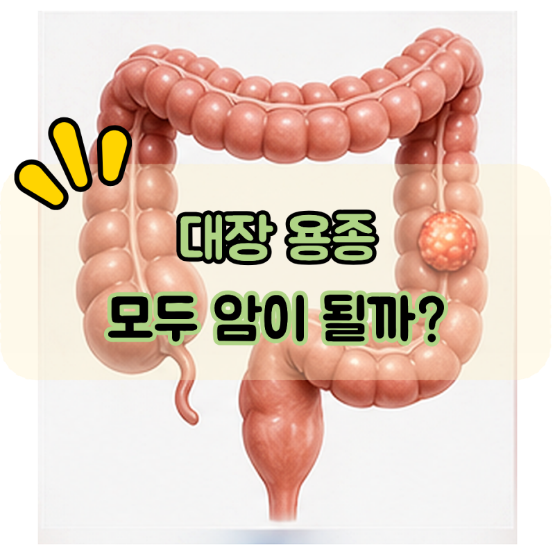 “대장 용종이 나오면 암으로 진행할까?” 선종과 대장암의 관계