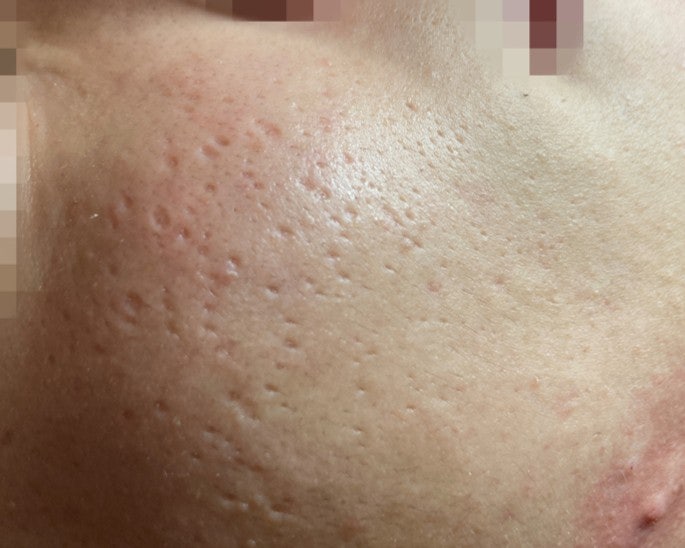 분당대상포진흉터 수두 자국은 시간이 지나면 없어지나요?