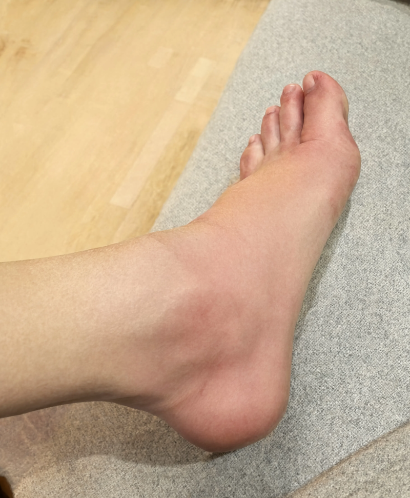 발목 접질렀을 때 냉찜질 온찜질 뭐가 먼저인가요?