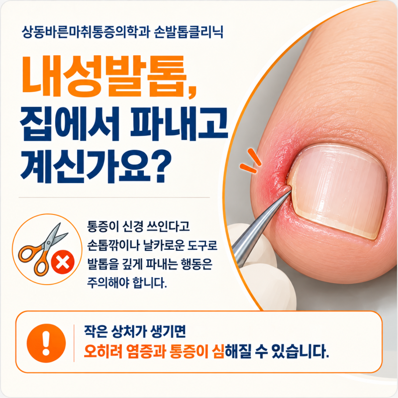 상동내성발톱 아프다고 집에서 파내고 계신가요? 잘못된 자가치료의 위험성
