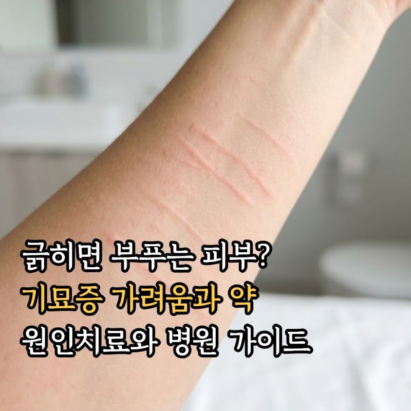 피부 기묘증? 피부묘기증 원인과 가려움 잡는 치료방법! 증상성 피부묘기증 약, 병원, 아기 ....