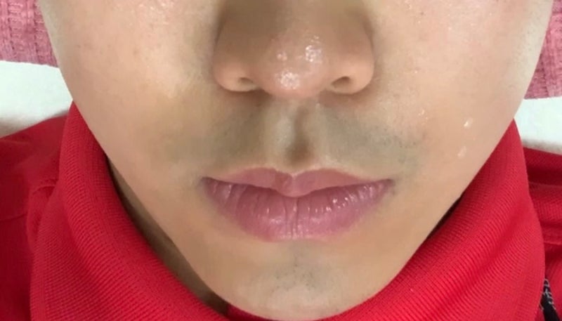 20대 남자 피부관리: 제모, 레티놀, 나이아신아마이드, 비타민C