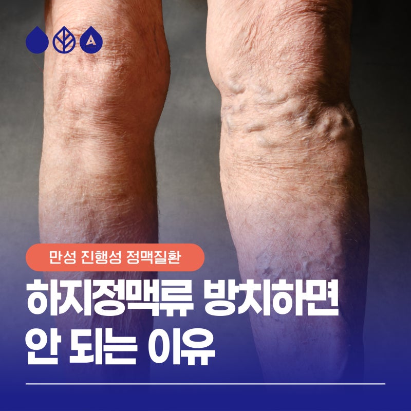 부산 하지정맥류, 방치 시 다리 건강에 미치는 영향