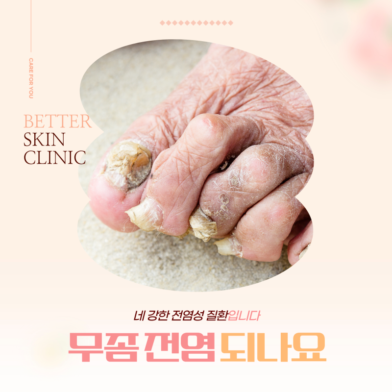 무좀 전염 되나요 : 네 강한 전염성 질환입니다 (전염 방지 방법)
