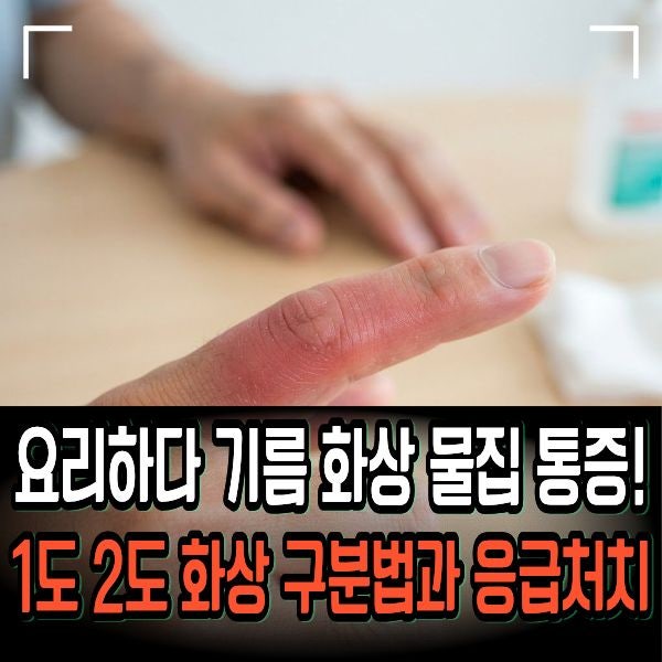 요리하다 기름 화상 물집 통증! 1도 2도 화상 구분법과 응급처치