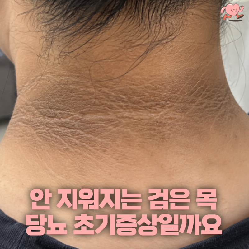 “목에 때가 낀 줄 알고 계속 문질렀어요” 안 지워지는 검은 목, 당뇨 초기증상일까?