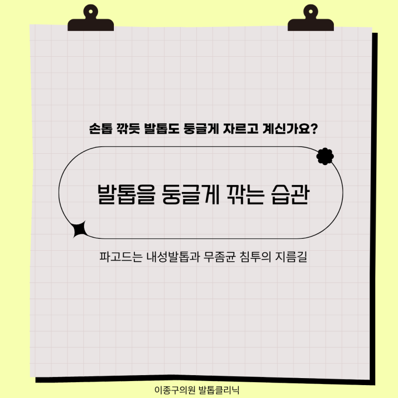 [안양무좀병원] 손톱처럼 둥글게 깎는 발톱, 내성발톱과 무좀균 침투의 지름길입니다!