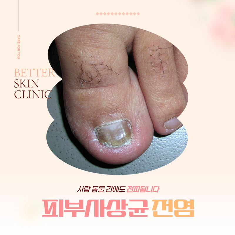피부사상균 전염 : 사람 동물 간에도 전파됩니다