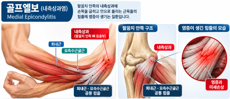 테니스엘보와 헷갈리는 골프엘보, 통증 위치로 30초 만에 구별하는 법(내측상과염)