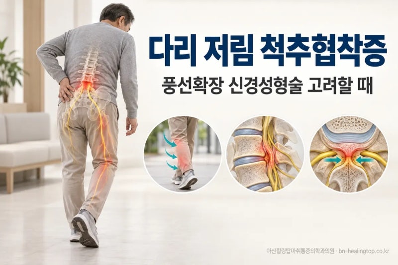 척추협착증 풍선확장술, 어떤 경우에 하는 시술일까요?