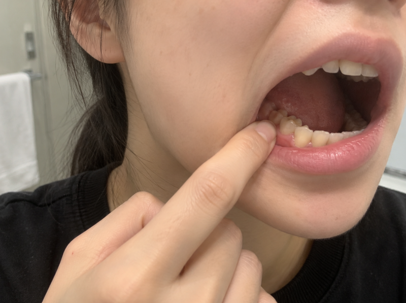 어금니 잇몸 통증 원인부터 치료까지, 붓고 욱신거릴 때 꼭 알아둘 것