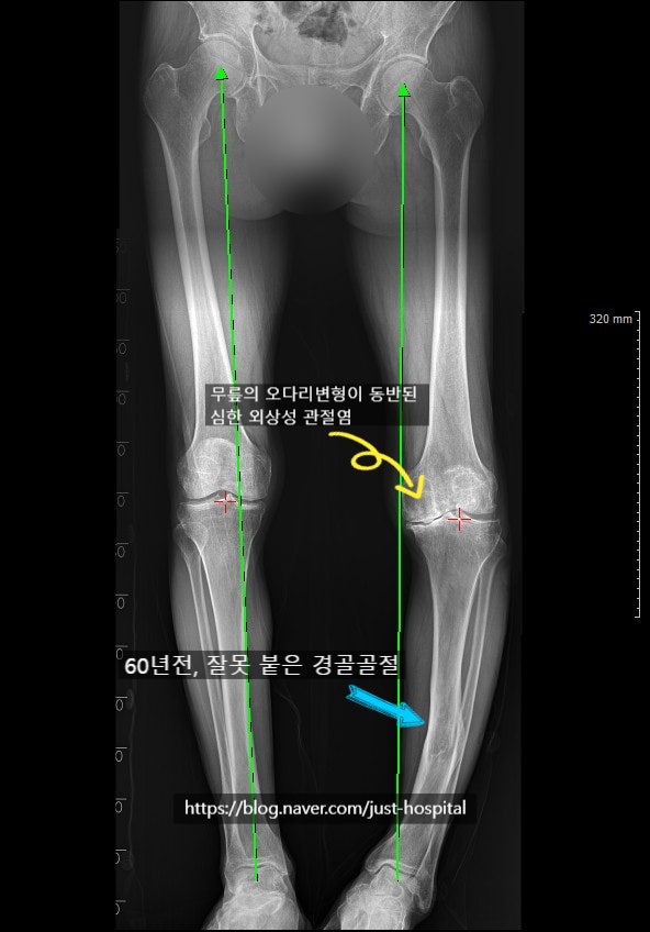 로봇 수술기를 이용한 무릎 인공관절 수술 : 외상성 무릎 관절염 환자의 로봇수술기를 이용....