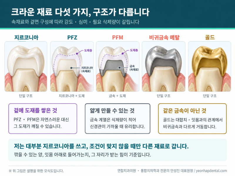 수원치과 치아 크라운 종류, 어떤걸 선택해야 하나요