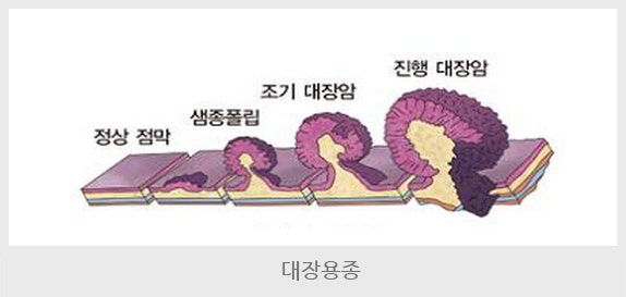 대장 용종 크기별 암 위험도 정리 : 1cm 넘으면 위험할까?