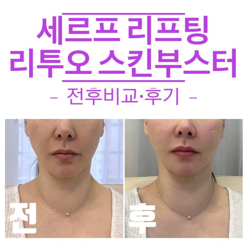 서울 강남역 피부과 ː 써마지 저렴이 버전 세르프 리프팅 · 리투오 스킨부스터 · 해미간보....