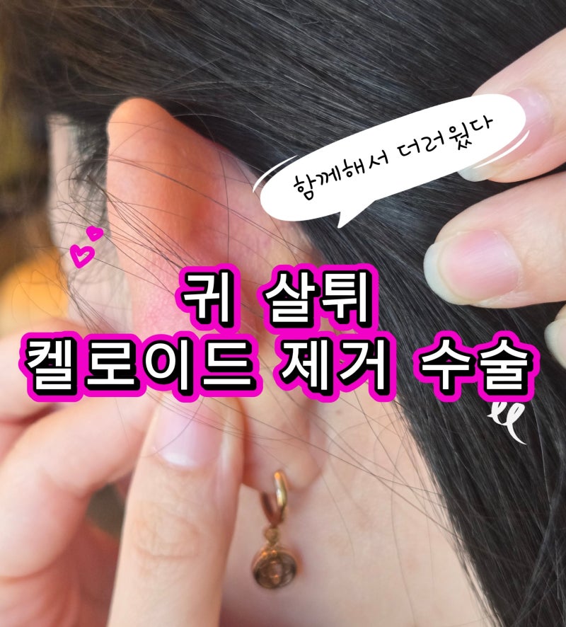 귀 살튀 켈로이드 제거 수술 후기(비용, 통증, 실비 보험 적용)
