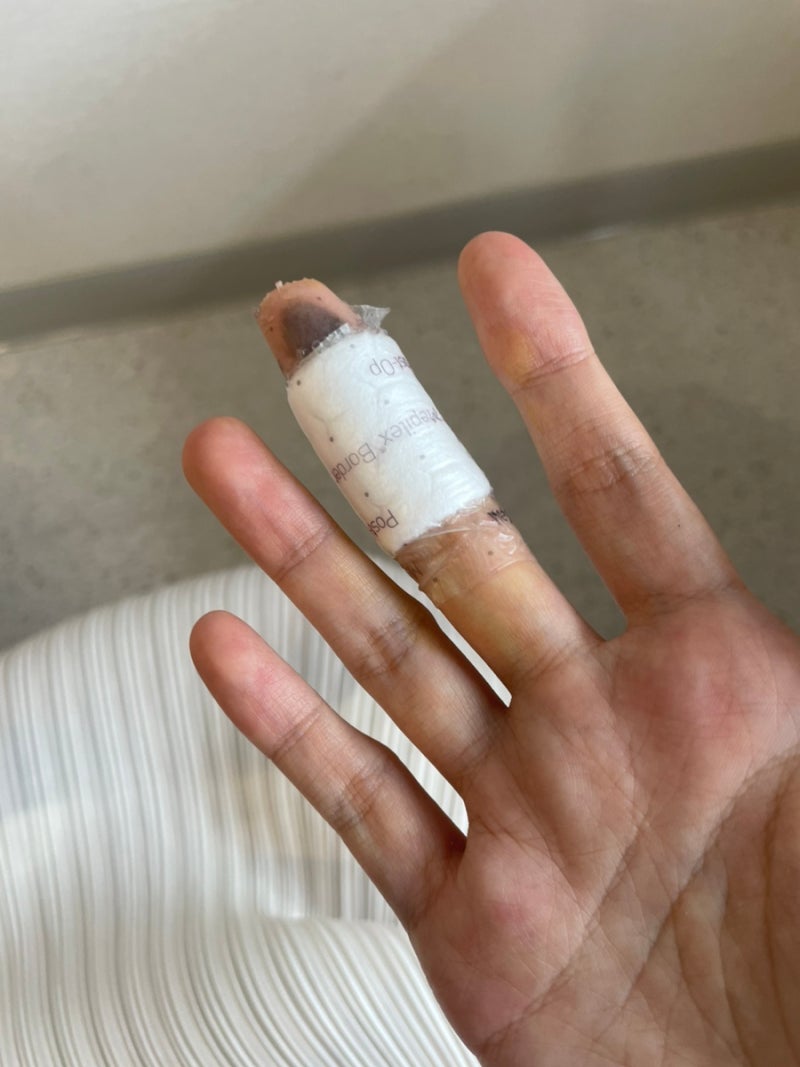 삼성서울병원 피부과 조직검사 후기(흑색종,피부암 의심)
