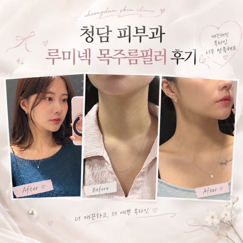 예신관리 필수♀️ 청담 목주름필러 루미넥 | 1회차~리터치 2회차 후기