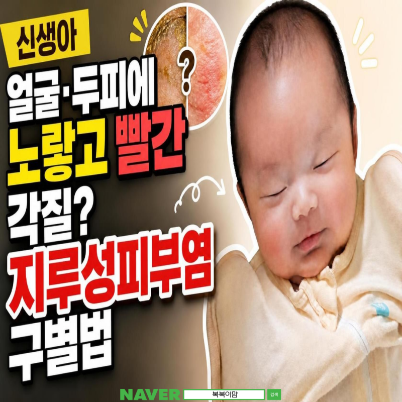 신생아 얼굴·두피에노랗고 빨간 각질?지루성피부염 구별법