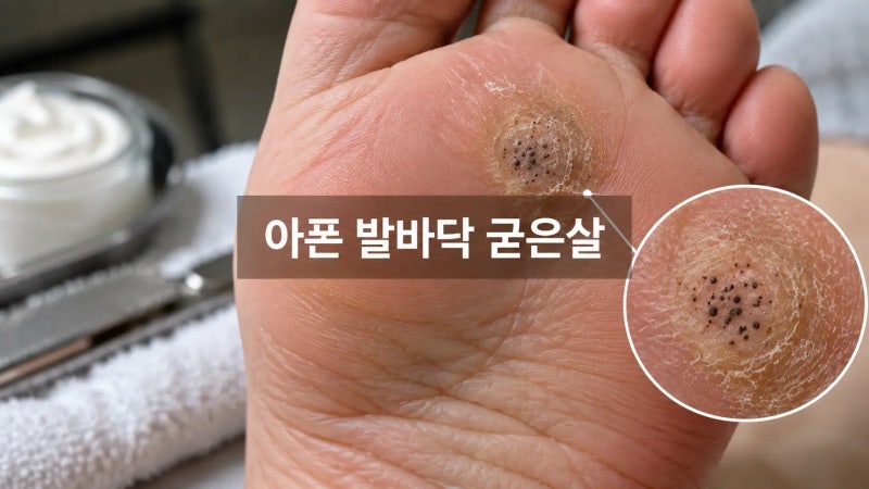 발바닥 굳은살 계속 깎으면 끝? 티눈·사마귀일 수도 있습니다
