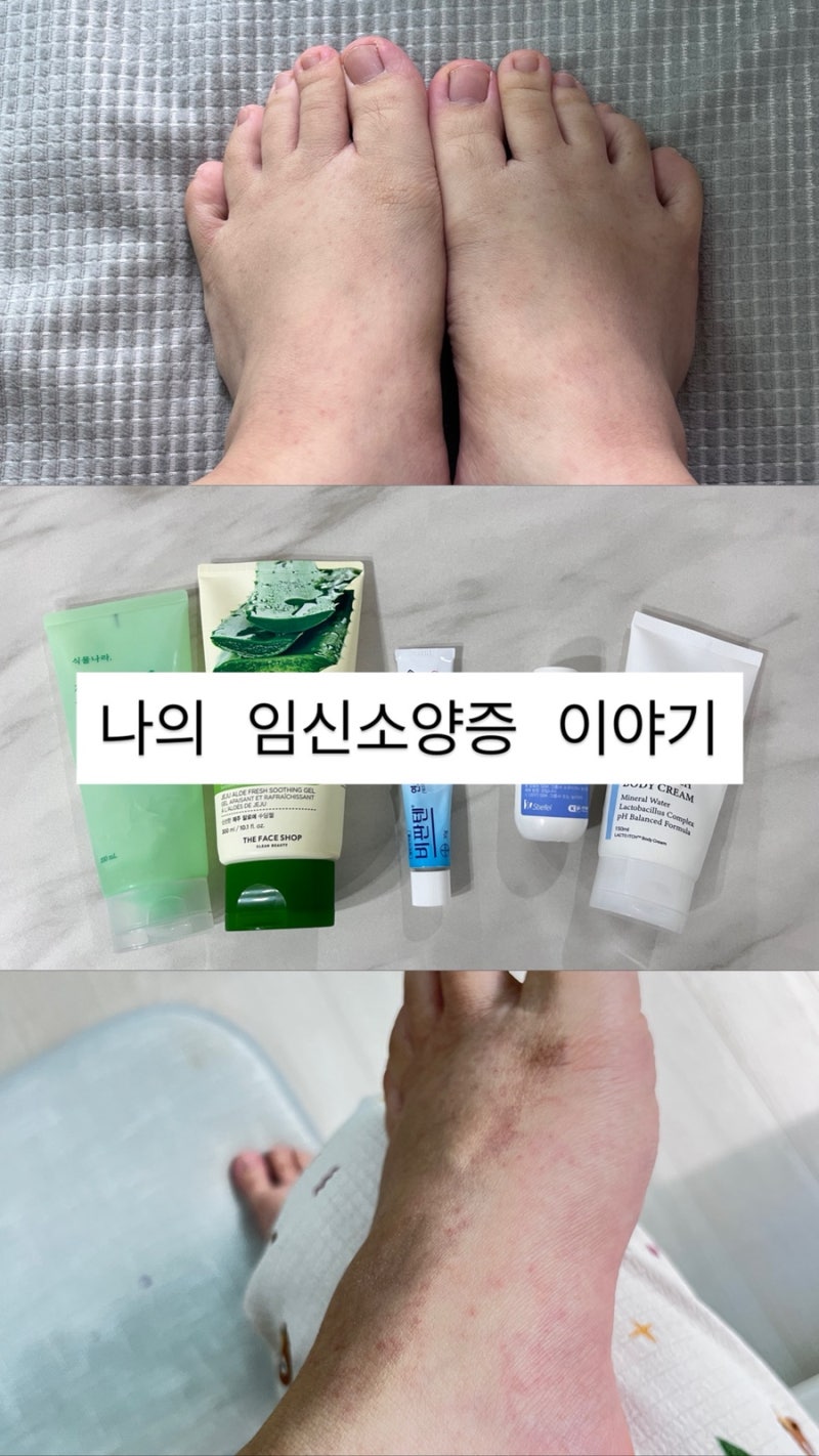 나의 임신 소양증 이야기 : 케어 루틴 / 시간이 답이다!