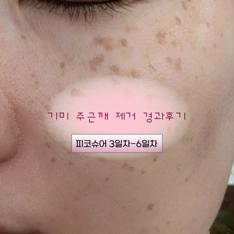 대구 기미 주근깨 잡티 제거 1회 후 3-6일차 경과 후기 피코 슈어 레이저 토닝 효과 내돈내산