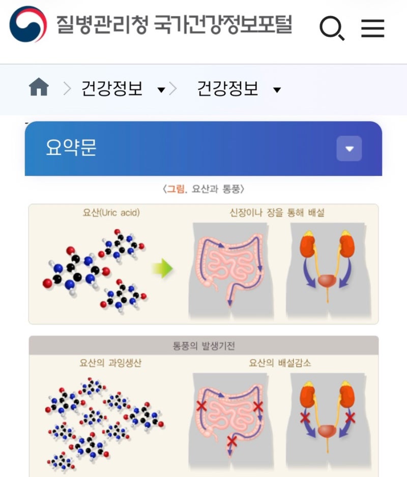 통풍 원인 증상 치료방법 총정리｜통풍에 좋은 음식과 피해야 할 음식