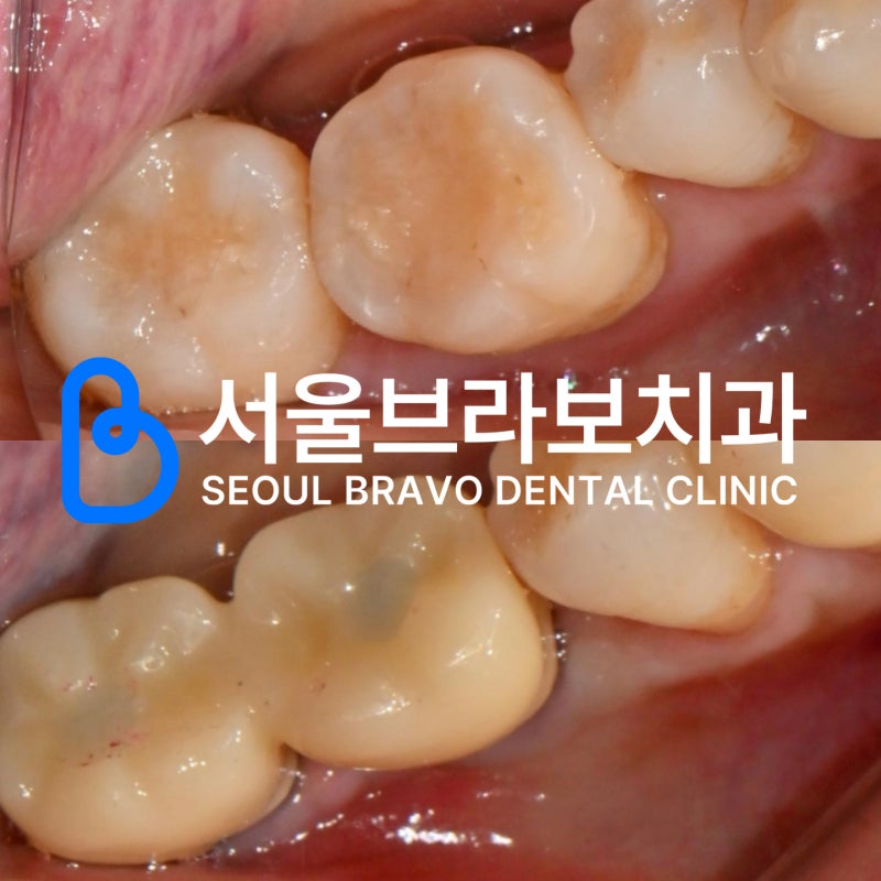 뼈이식 임플란트 수술 후 식사 메뉴, 음주, 양치 가능 여부 주의점