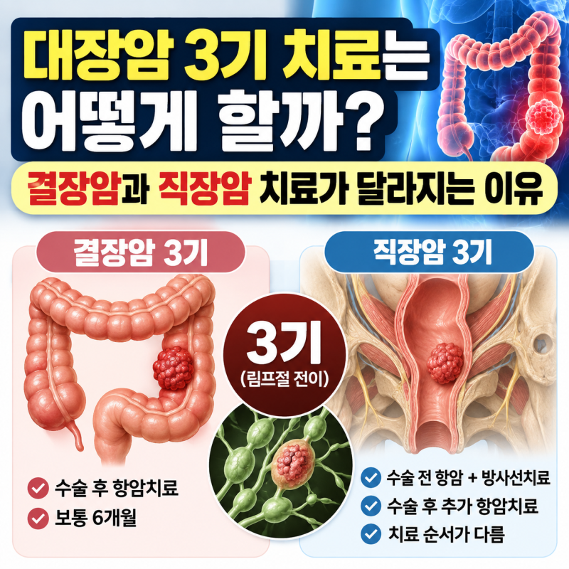 대장암 3기 치료는 어떻게 할까? 결장암과 직장암 치료가 달라지는 이유