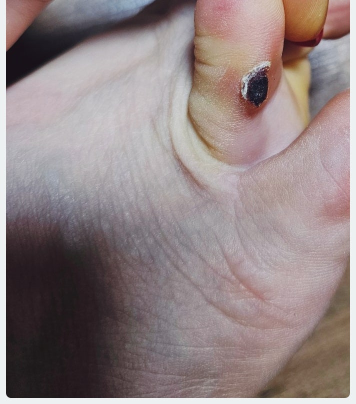5년 넘게 괴롭히던 발가락 티눈, 어느 날 통째로 떨어졌습니다