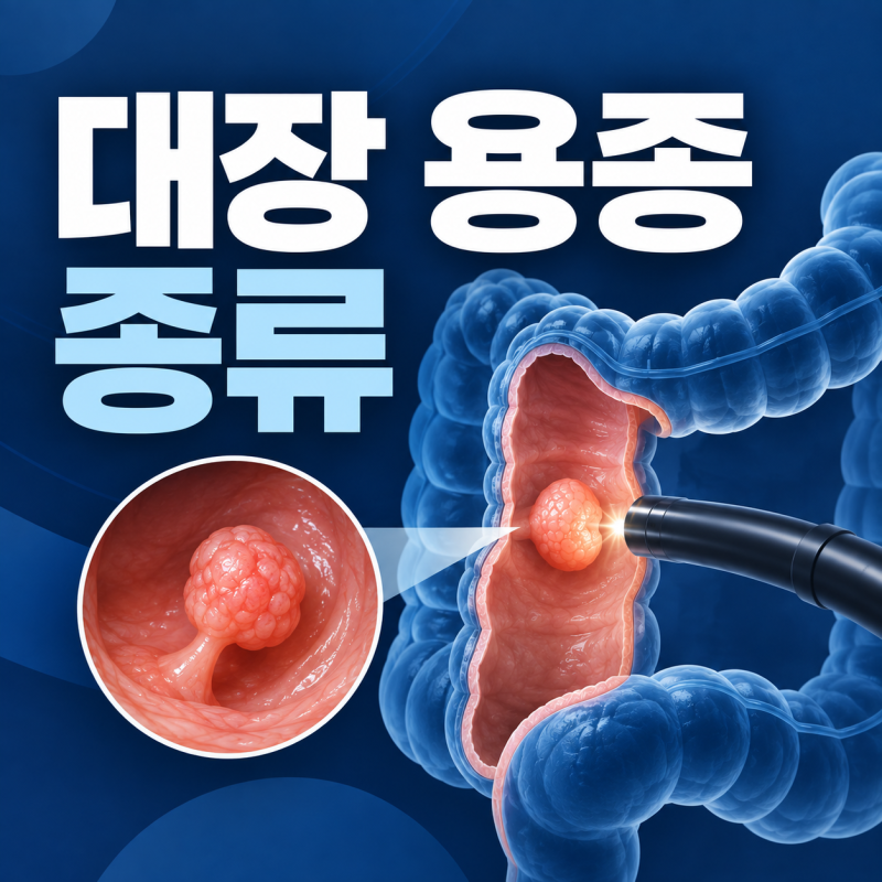 대장내시경 용종 종류, 모두 대장암으로 진행되는 걸까요?
