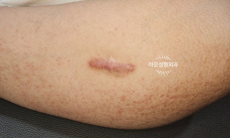 스테로이드 주사에 효과 없는 켈로이드, 5-FU 주사에 효과 볼 수 있을까? (서울 강동구 아문성....