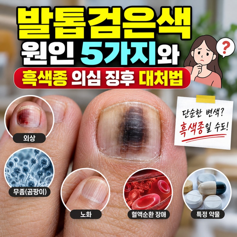 발톱검은색, 원인 5가지와 흑색종 의심 징후 대처법