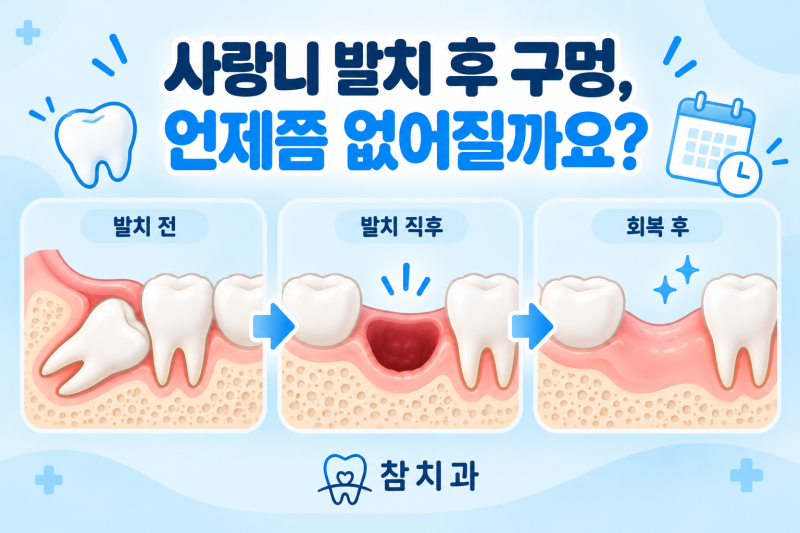 장유 치과 사랑니 발치 후 구멍, 언제쯤 없어질까요?