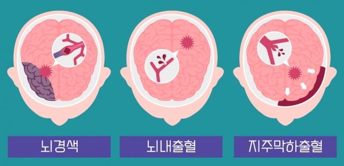 뇌혈관질환 뇌출혈 산업재해보상