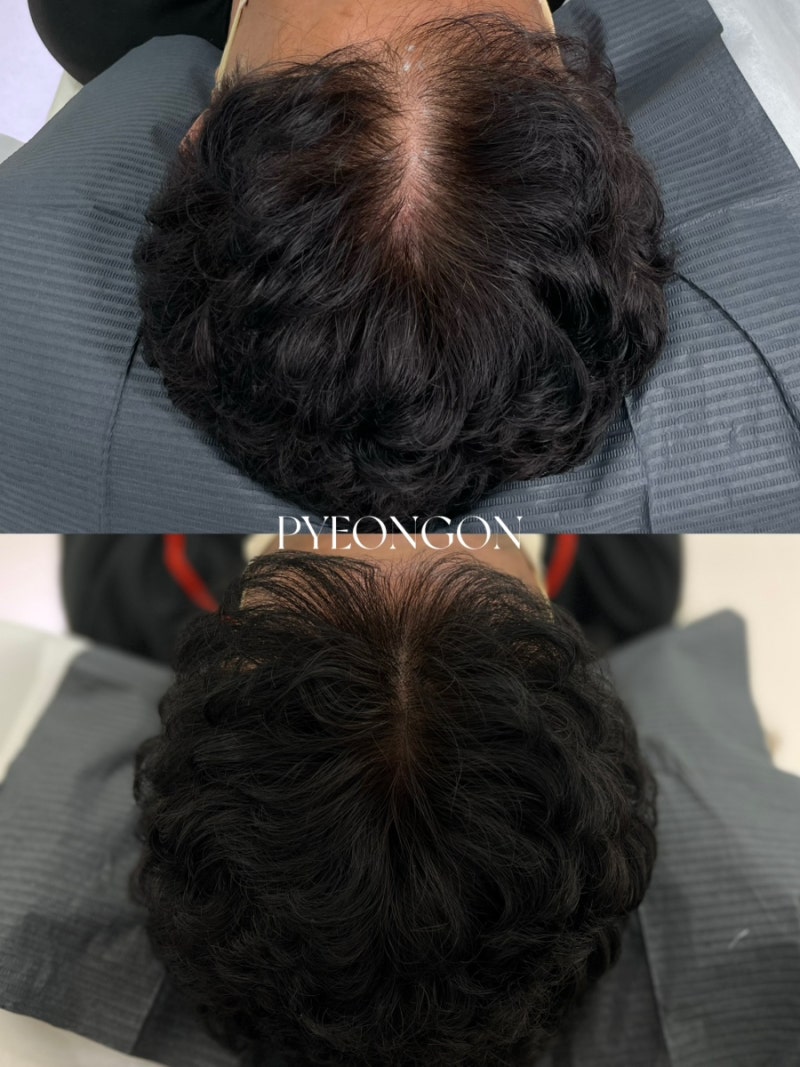 전남 광주 나주 남자 정수리 가르마 탈모로 스트레스 받는다면 ? 두피문신으로 해결하세요