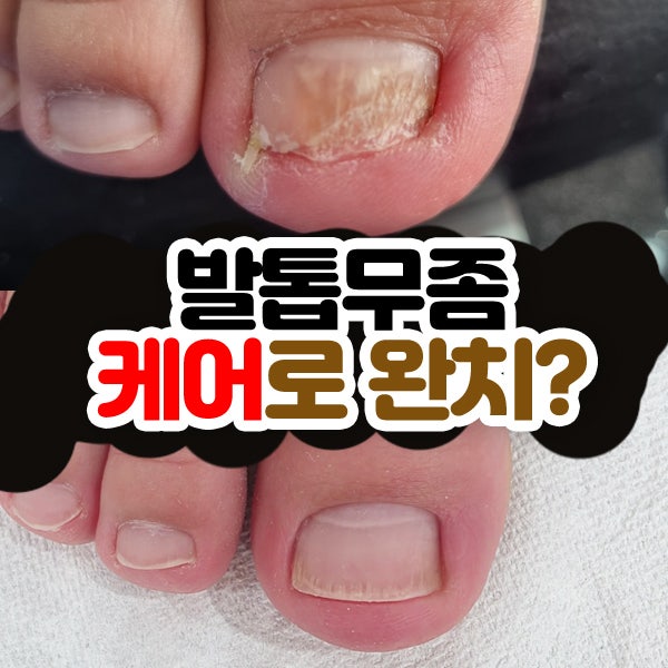 광주 발톱무좀 독한 약? 레이저 치료? 케어로 완치된 후기
