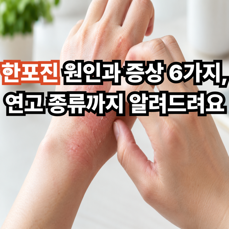 한포진 원인과 증상 6가지, 연고 종류까지 알려드려요