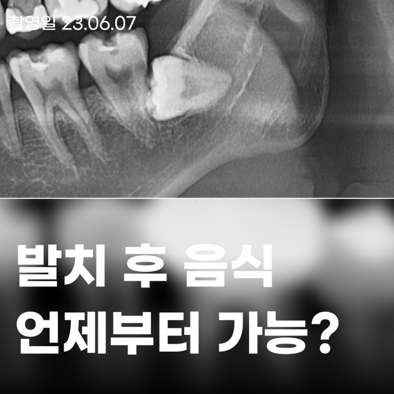 매복사랑니 발치 후 식사 언제부터?