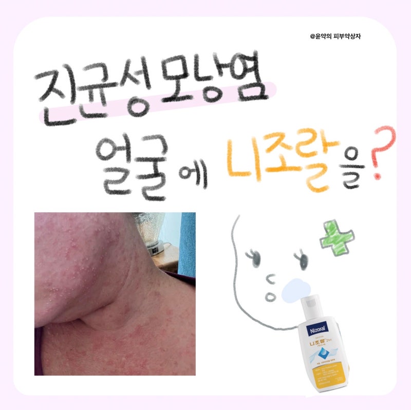 진균성모낭염 (말라세지아 모낭염) 혹시 니조랄 샴푸 얼굴 몸에 사용해도되나요?