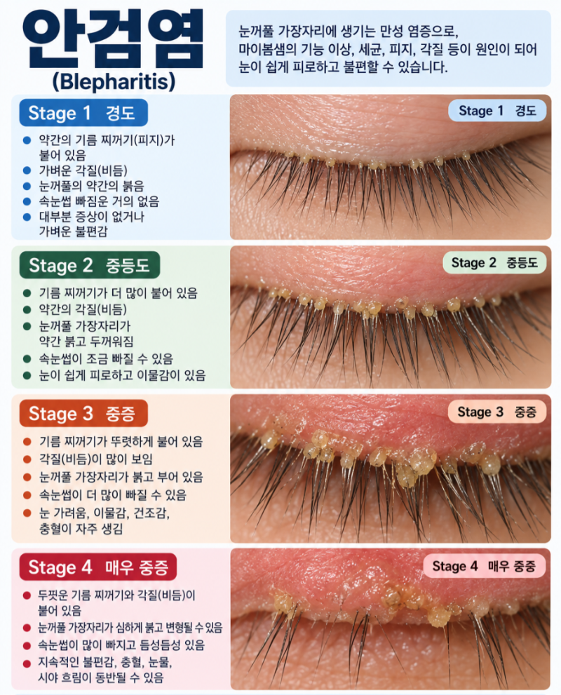 [호치민 김안과] 안검염(Blepharitis)
