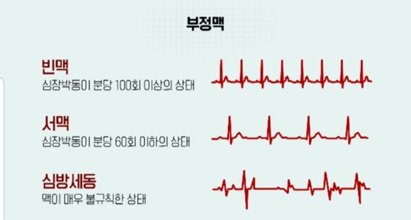 부정맥 증상·원인·치료 총정리｜심장이 불규칙하게 뛴다면 꼭 알아두세요
