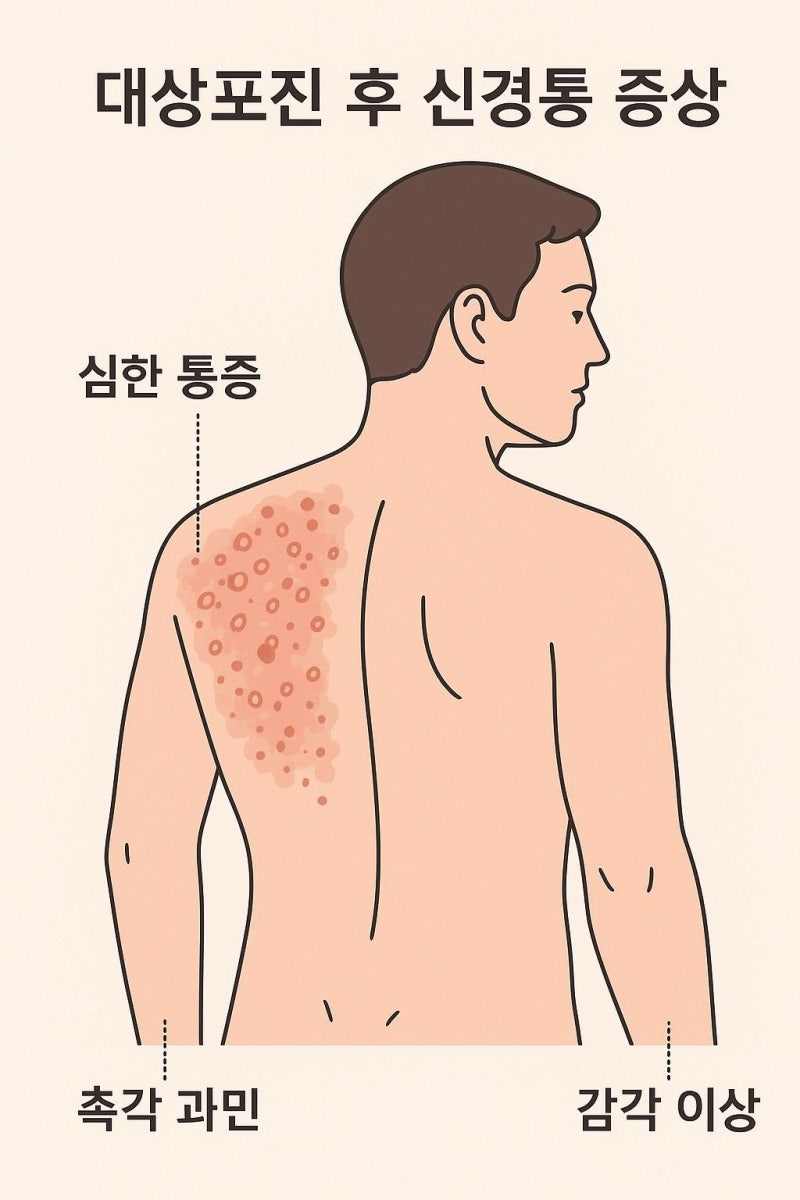 대상포진 예방접종 종류와 비용 총정리! 가장 가성비 좋은 접종 방법은?